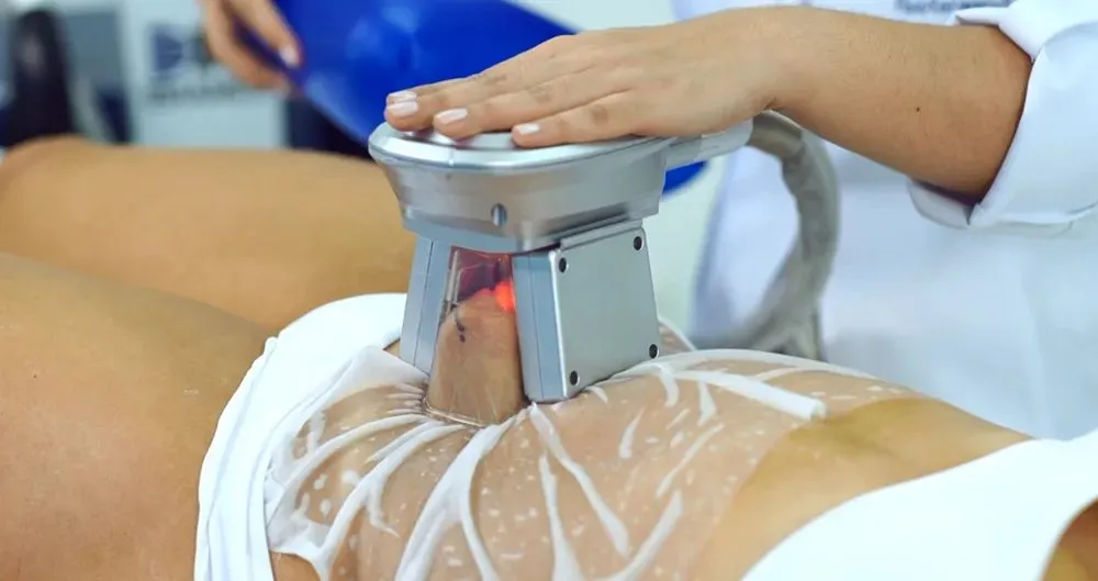 Criólipolise na barriga